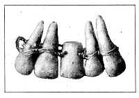 Examples of dental prosthesis