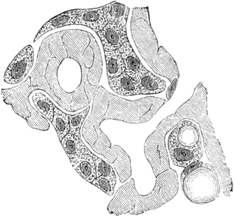 Amyloide Degeneration