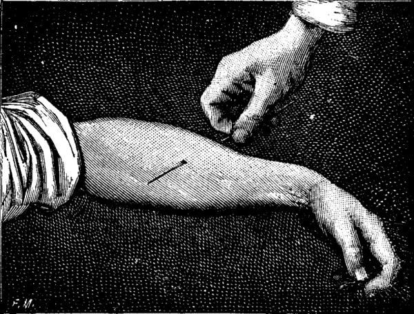 FIG. 4.&mdash;AN ARM TRANSPIERCED BY A NEEDLE.