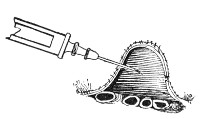 Fig. 183.&mdash;Section of abdominal wall, etc., showing point
of needle lying free in the peritoneal cavity above the coils of
intestine.