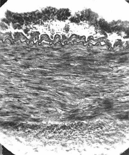 Fig. 1.&mdash;Cross section of a large artery showing the division into the three coats; intima,
media, adventitia. The intima is a thin line composed of endothelial cells. The
wavy elastic lamina is well seen. The thick middle coat is composed of muscle fibers
and fibroelastic tissue. The loose tissue on the outer (lower portion of cut) side of the
media is the adventitia. (Microphotograph, highly magnified.)
