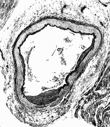 Fig. 2.&mdash;Cross section of a coronary artery, ×50, showing nodular sclerosis. Note the
heaping up of cells in the intima, the fracture of the elastica, and the destruction of the
media beneath the nodule. The primary lesion evidently was in the media. The thickened
intima is the effort on the part of nature to heal the breach. At such places as
shown here aneurysms may form. (Microphotograph.)