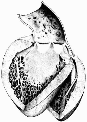 Fig. 4.&mdash;Arteriosclerosis of the arch of the aorta. Numerous calcified plaques,
thickening and curling of the aortic valves, giving rise to insufficiency of the aortic
valves. The aortic ring is rigid and not much dilated. (Milwaukee County Hospital.)