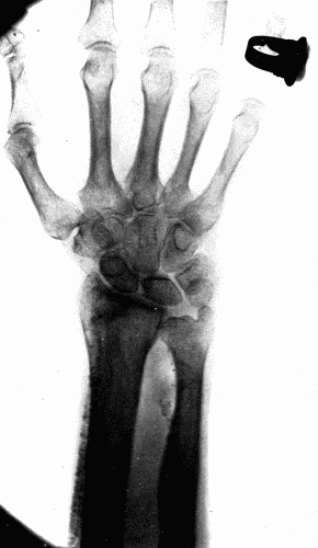 Fig. 6.&mdash;Radiogram of a man aged seventy-five, showing calcification of both radial and
ulnar arteries.