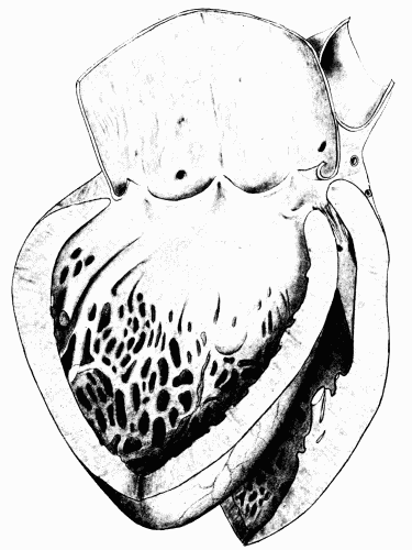 Fig. 7.&mdash;Syphilitic aortitis of long standing. The aortic valves are curled and
thickened, the heart is enlarged and the cavity of the left ventricle is dilated. (Milwaukee
County Hospital.)