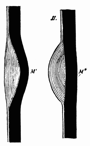 Fig. 8.&mdash;I, media weakened at M' with overgrowth of intima filling in the depression.
II, with postmortem rigor and contraction of the muscles of the media and removal
of the blood pressure from within, the stretched media at M'' contracts; the intimal
thickening thus projects into the arterial lumen. (After Adami.)