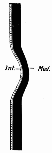 Fig. 9.&mdash;Schematic representation of the increased strain brought to bear upon the
cells of the intima, Int., when the media, Med., undergoes a localized expansion through
relative weakness. (After Adami.)
