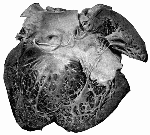 Fig. 12.&mdash;Aortic incompetence with hypertrophy and dilatation of left ventricle, the
result of arteriosclerosis affecting the aortic valves. Note how the valves have been curled,
thickened, and shortened, the edges of valves being a half inch below the upper points
of attachment. The anterior coronary artery is shown, the lumen narrowed. (Reduced
one-half.)