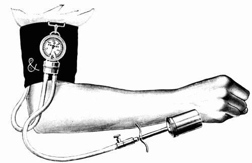 Fig. 20.&mdash;Faught dial instrument.