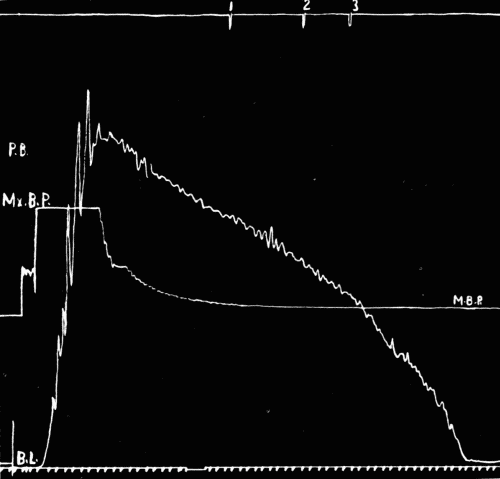 Fig. 29.&mdash;Tracing of auscultatory phenomena. (See explanation in legend of Fig. 30.)