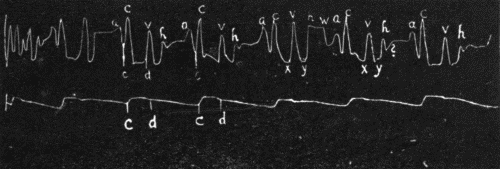 Fig. 37.&mdash;Jugular and carotid tracing from a normal individual with a well-marked
third heart sound showing a large "h" and a smaller pre-auricular wave "w." ? indicates
a small wave in mid-diastole following the "h" wave, occasionally found though
perhaps an artefact. (After Hirschfelder.)