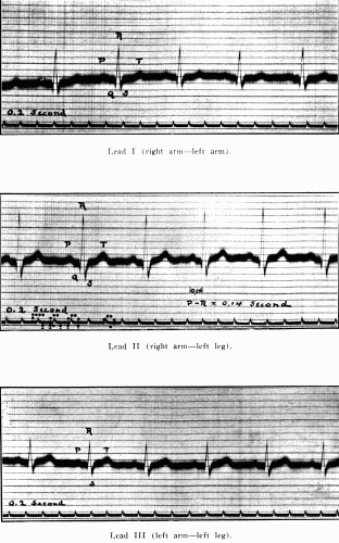Fig. 39.&mdash;Normal electrocardiogram. (After Hart.)