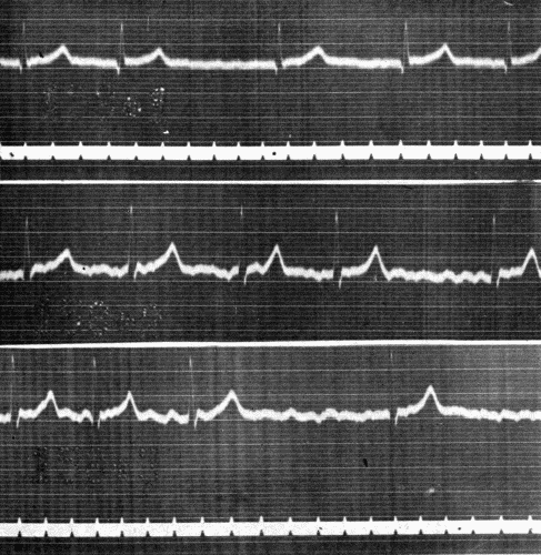 Fig. 41.&mdash;Electrocardiogram showing auricular fibrillation in Leads I (upper) and II
(middle and lower). (Courtesy of Dr. G. C. Robinson.)