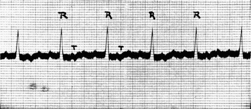 Fig. 42.&mdash;Auricular fibrillation. (After Hart.)