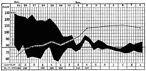 Fig. 43.&mdash;The shaded area represents the pulse deficit; the upper edge is the apex
rate, the lower edge the radial rate. The broken line indicates the "average systolic
blood pressure." (Compare these values with the figures at the bottom of the chart,
which show the systolic blood pressure determined by the usual method.) (After Hart.)