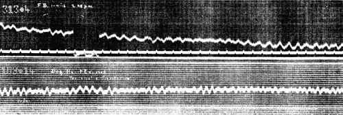 Fig. 44.&mdash;Upper curve. Record obtained during period of cardiac syncopy at 2:48 p.m., Lead II. Lower curve from dog.
Ventricular fibrillation observed in the exposed heart. Lead from right foreleg and left hind leg. (Courtesy of Dr. G. C. Robinson.)