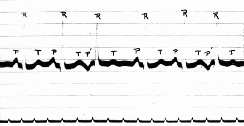 Fig. 45.&mdash;Electrocardiogram showing auricular extrasystoles (P). (Courtesy of Dr. G. C.
Robinson.)