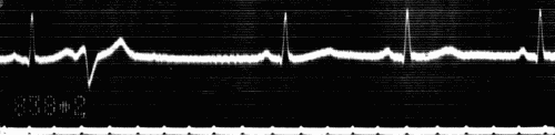 Fig. 46.&mdash;Electrocardiogram showing ventricular extrasystole. Heart rate 56-60
beats per minute. Note that diastolic pause in which extrasystole occurs is practically
equal to two normal diastolic pauses. (Courtesy of Dr. G. C. Robinson.)