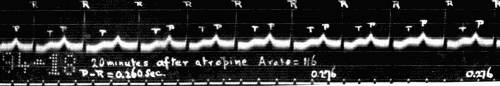 Fig. 47.&mdash;Electrocardiogram showing delayed conduction (lengthening of P-R interval).
These P-R intervals are quite regular. When irregular there is apt to be extrasystole
of ventricle or occasional blocking of impulse going to ventricle. (Courtesy of
Dr. G. C. Robinson.)