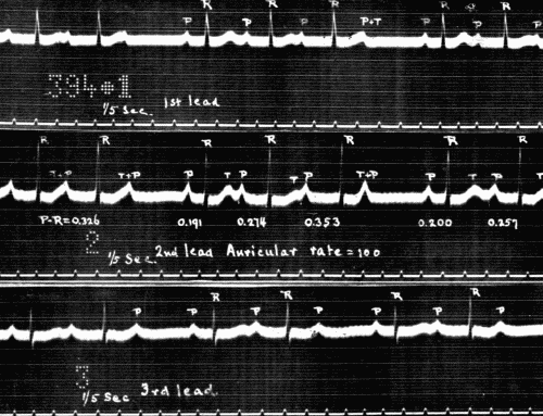 Fig. 48.&mdash;Electrocardiogram showing partial heart-block in the three leads. Note
the variability of P-R interval calculated in seconds in Lead II. (Courtesy of Dr.
G. C. Robinson.)