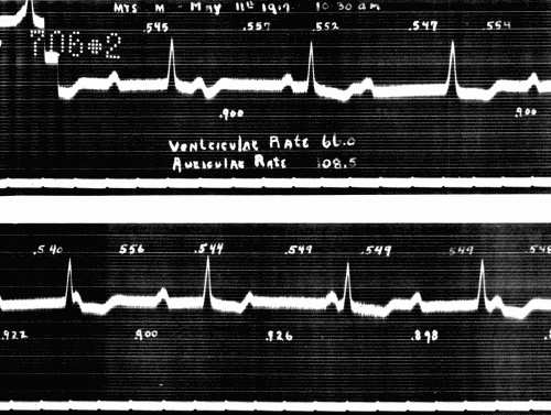 Fig. 49.&mdash;Complete heart block. (Courtesy of Dr. G. C. Robinson.)