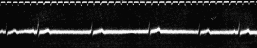 Fig. 50.&mdash;Showing alternating periods of sinus rhythm and auriculoventricular rhythm.
(After Eyster and Evans.)