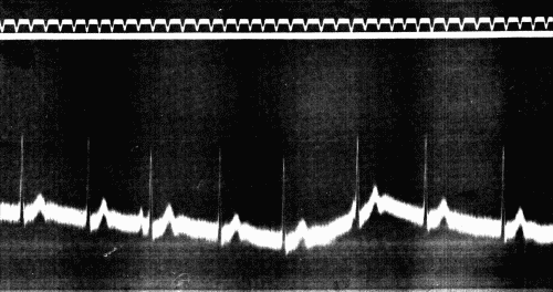 Fig. 51.&mdash;Period of auriculoventricular or "nodal" rhythm following exercise in sitting
posture. (After Eyster and Evans.)