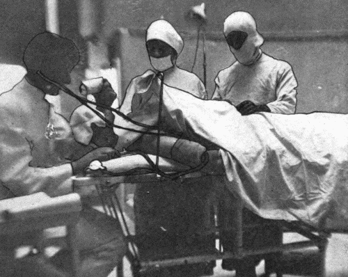 Fig. 56.&mdash;Showing method of using blood pressure instrument during operation without
interfering with the operator or assistants. Sheet thrown back to show cuff on
arm of patient. Anesthetist has chart on table beside him, dial pinned to pad in full
view, bulb near hand. Extra tubing must be put on the blood pressure instrument.