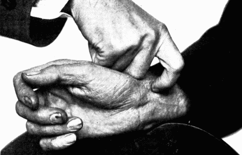 Fig. 57.&mdash;A method of finger-tip palpation of the radial artery. (Graves.)