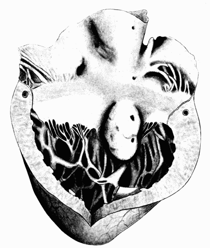 Fig. 59.&mdash;Aneurysm of the heart wall. (Milwaukee County Hospital.)