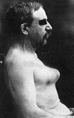 Fig. 60.&mdash;Large aneurysm of the aorta eroding the sternum. Death from rupture through
the skin preceded by frequent small hemorrhages. (Milwaukee County Hospital.)